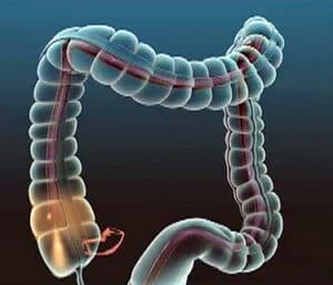 Endoscopy